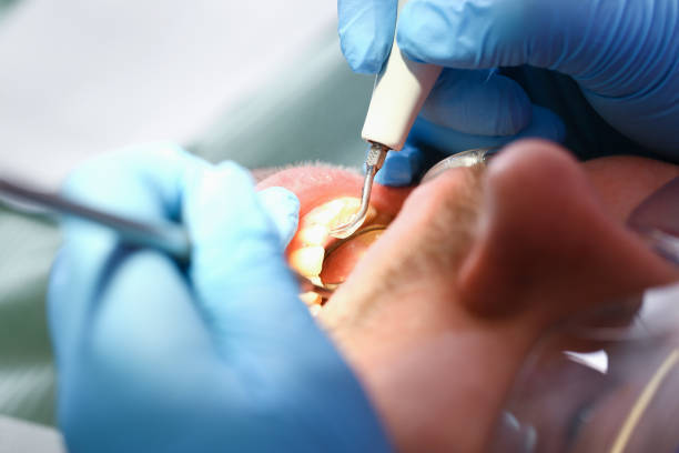Best Emergency Treatment for Dental Infections or Abscesses in Panhandle, TX